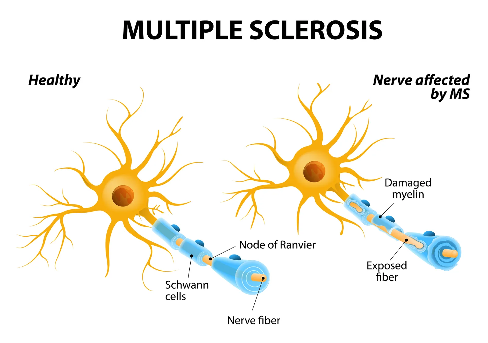 Diagram of Multiple Sclerosis and myelin damage